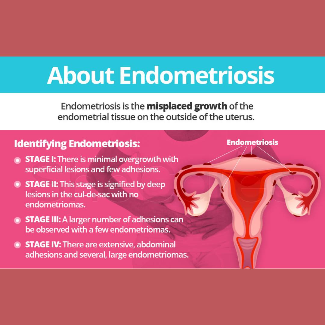 Understanding the Differences Between Endometriosis and PCOS - Eco Period Australia